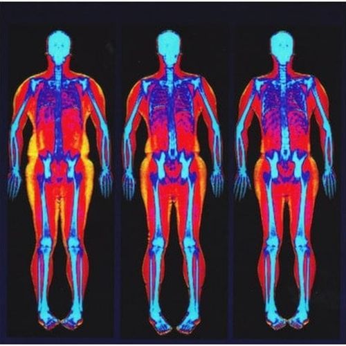 DEXA Scan