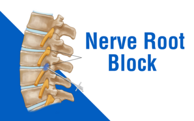 Nerve root block